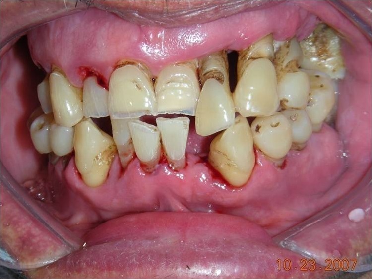 Periodontitis teeth