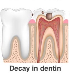 Decay in dentin