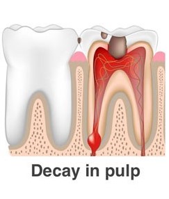decay in pulp