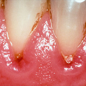 Gingivitis showing redness