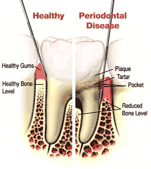PERIODONTAL DISEASE is bad for your health