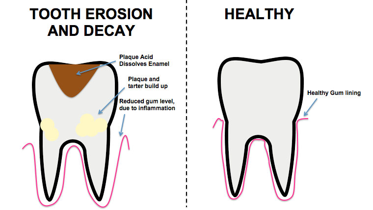 Tooth decay and erosion