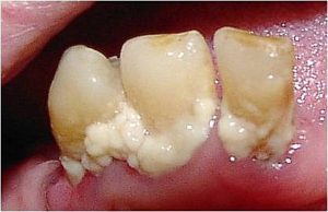 Tooth plaque